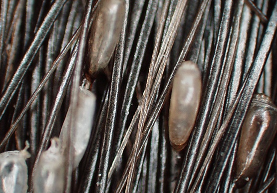 Woran Erkennt Man Ob Nissen Tot Sind Kopfläuse & Nissen: Alle Informationen | NYDA®